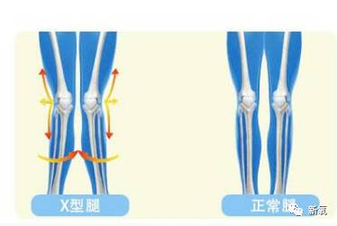 杨幂的X形腿允儿的O形腿都是怎么变直的?