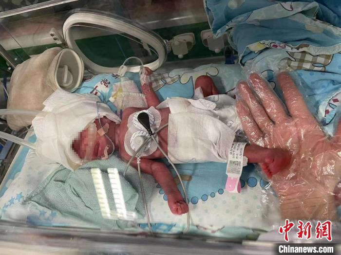 早产双胞胎呼吸衰竭 “闯关”44天脱险