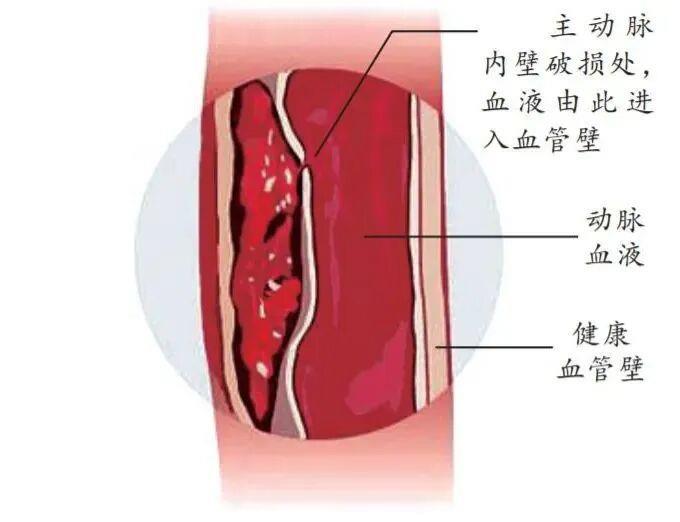防寒更要防病！医生提醒：别让低温“冻”破主动脉