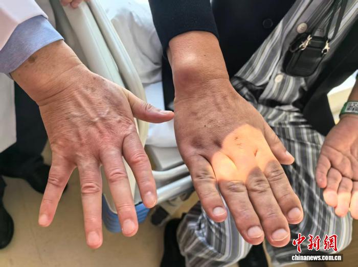 成年后鞋码还在长?别只当“发福” 专家:当心肢端肥大症